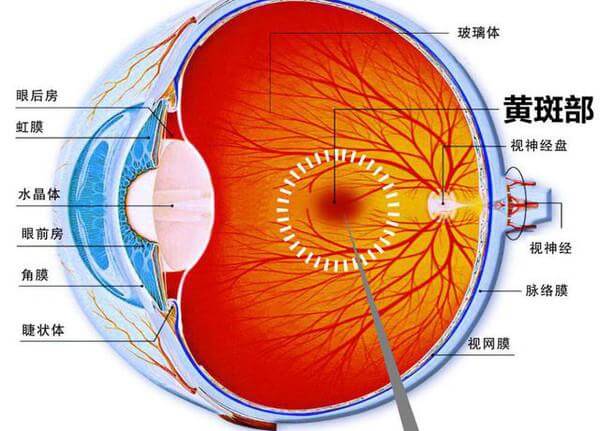 增龄性黄斑变性是由什么原因引起的？